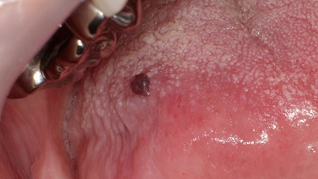 舌の血豆 ― 1週間後の経過所見