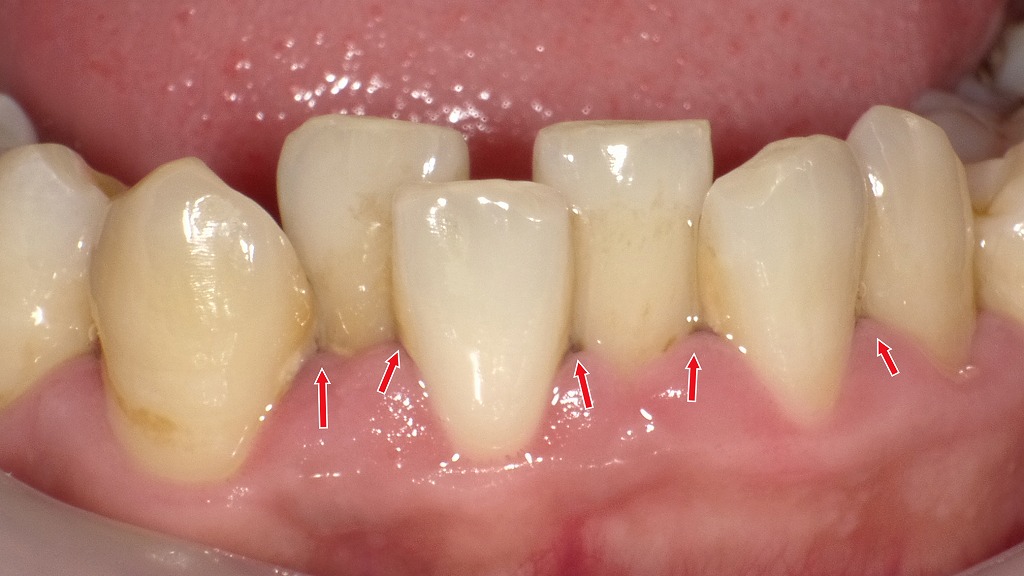 下の歯がガタガタだと歯周病が悪化しやすい理由