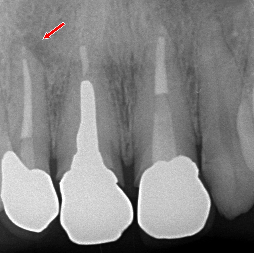 上顎2番の根尖部の透過像が消失し、骨再生が進行。メタルボンド装着後の良好な治癒経過。