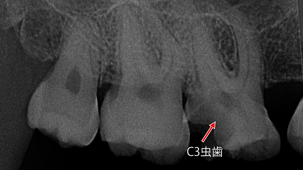 冷たいものがしみる原因 ― C3虫歯による神経への影響