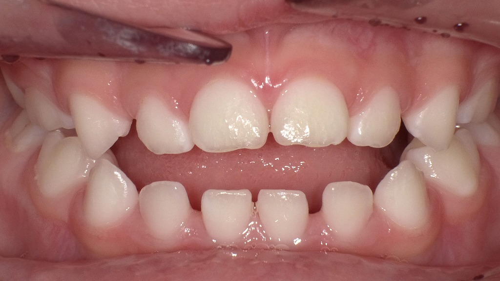 4歳児にみられる口腔機能発達不全症に伴う前歯部開咬（オープンバイト）