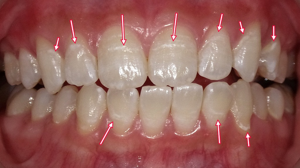 歯の脱灰が起こった症例