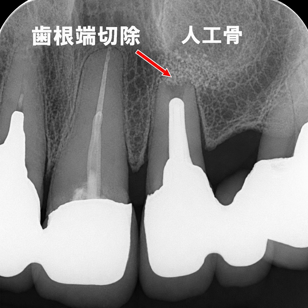歯根端切除術後3か月の経過観察像