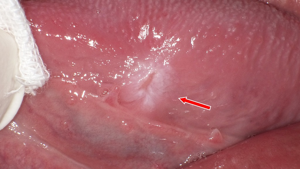 舌の側面に白く硬さを伴う潰瘍が見られる状態（矢印）。舌がんでも同様の症状が現れるため、早期に専門的な検査が必要です。