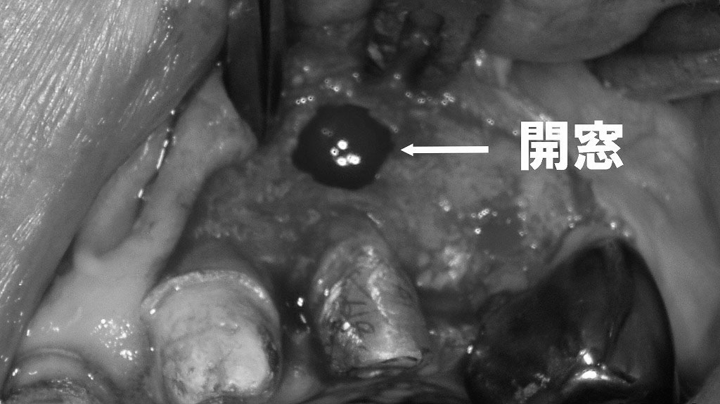 上顎犬歯部における歯根端切除術のための開窓