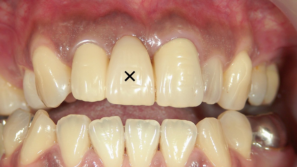 寿命がきた差し歯を抜歯後、ブリッジで回復した症例（右上顎1番）正面観