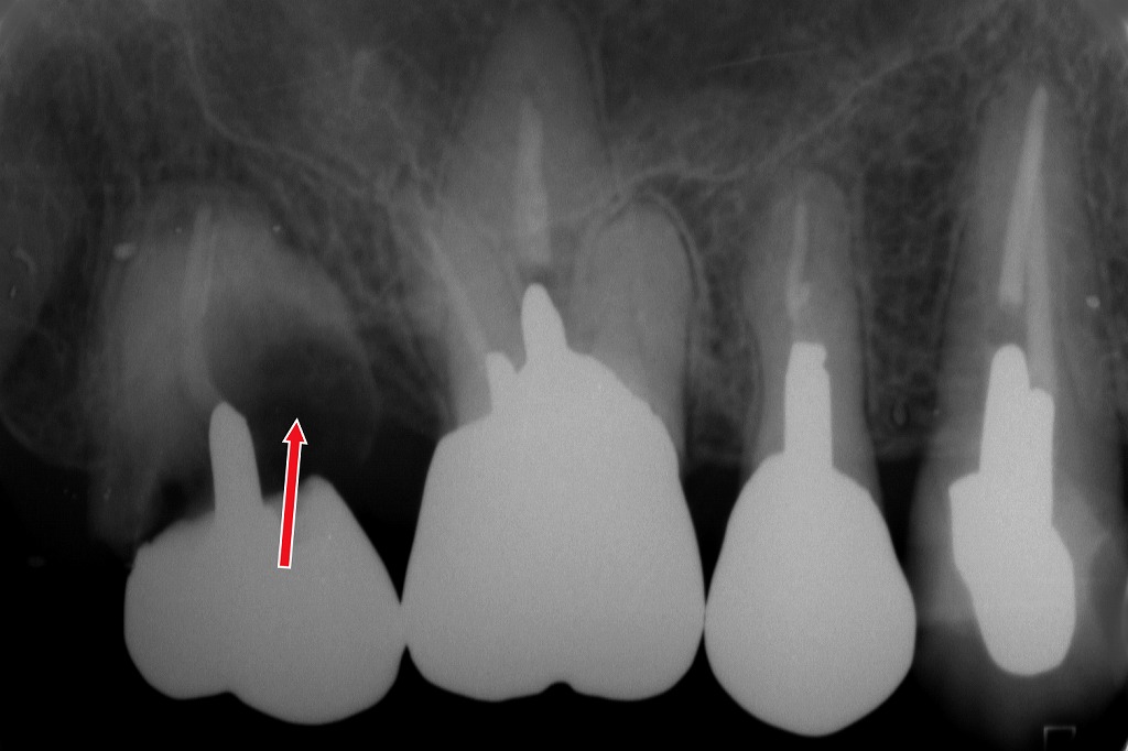 見えない場所で進行する銀歯の重度虫歯（C4）