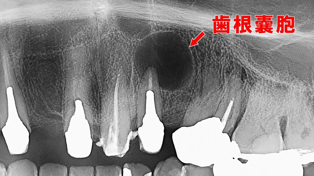 上顎左犬歯を原因とする歯根嚢胞