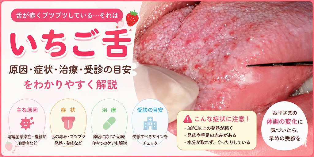 いちご舌とは