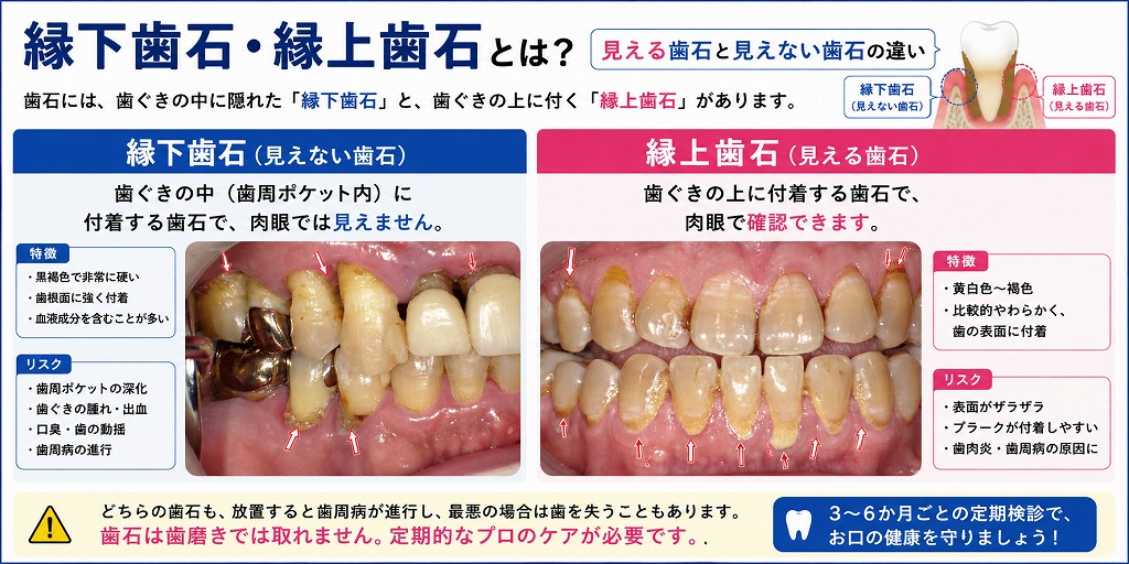 縁上歯石と縁下歯石の違い