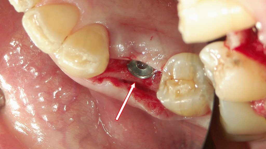 下顎右側第1小臼歯（4番）のインプラント症例