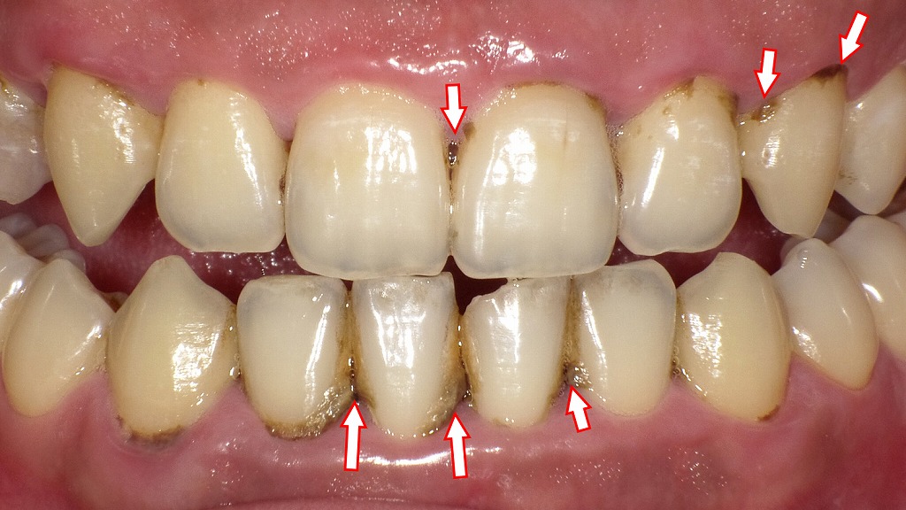 歯石が原因の口臭症例