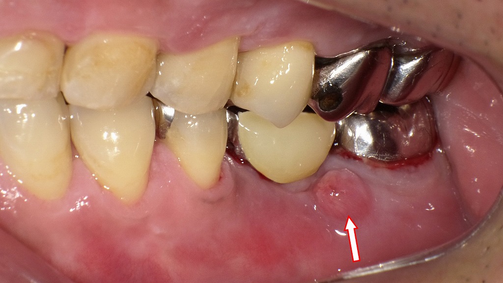 銀歯のフィステルが原因の口臭症例
