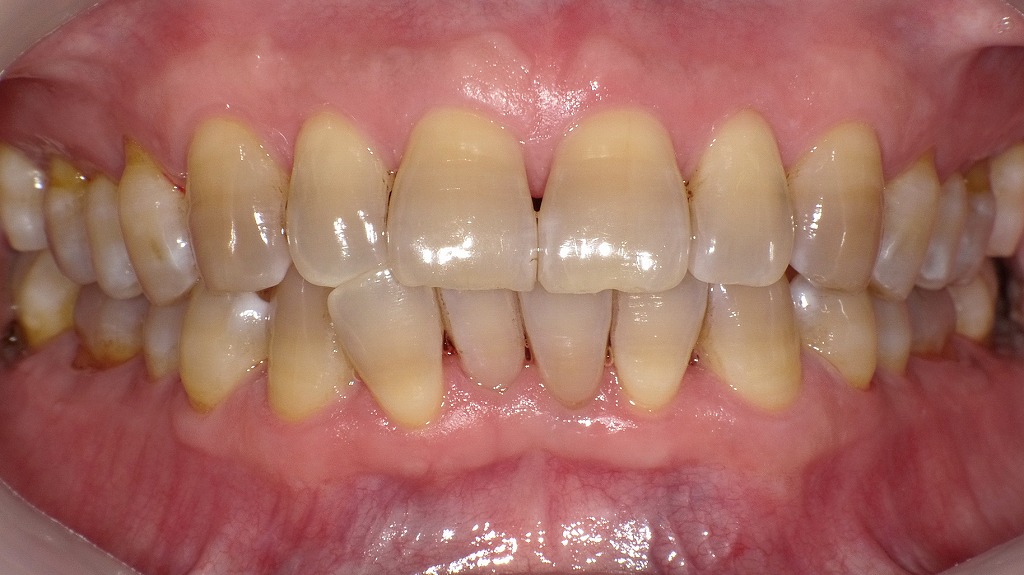 エアフローで着色が除去され、笑顔が一気に明るく見える口元に