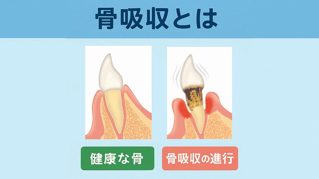 骨吸収とは？