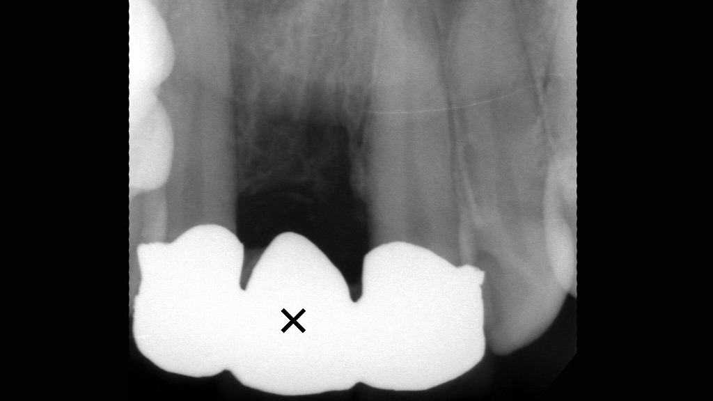 寿命がきた差し歯を抜歯後、ブリッジで補綴した症例（右上顎1番）