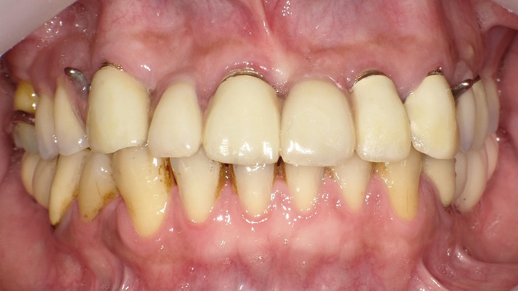 コーヌス義歯正面観