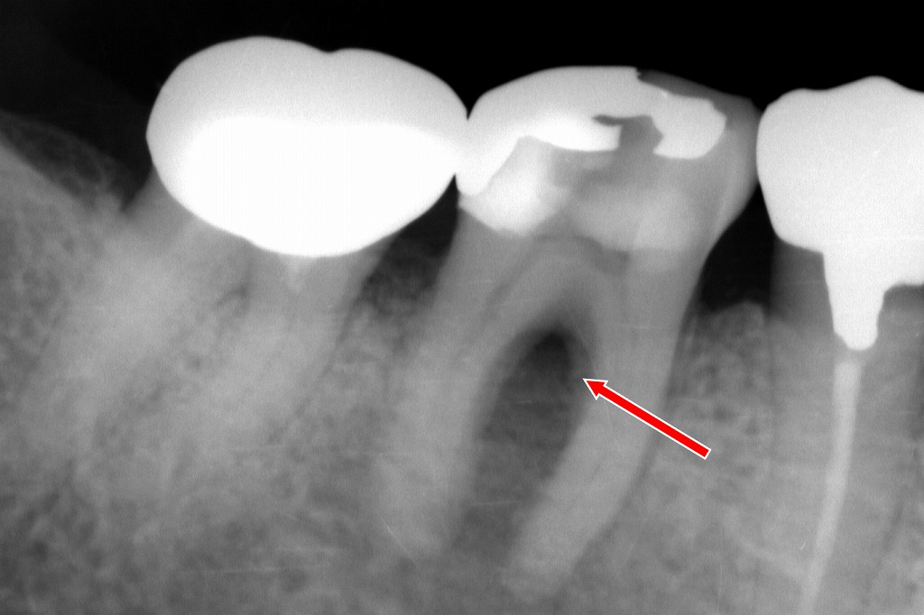 下顎６番根分岐部に広がる透過像。根分岐部病変を示すX線所見