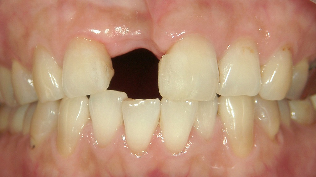 右上前歯の欠損