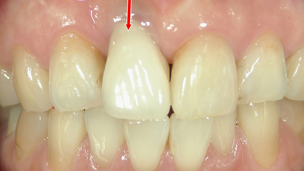 最終上部構造の装着後