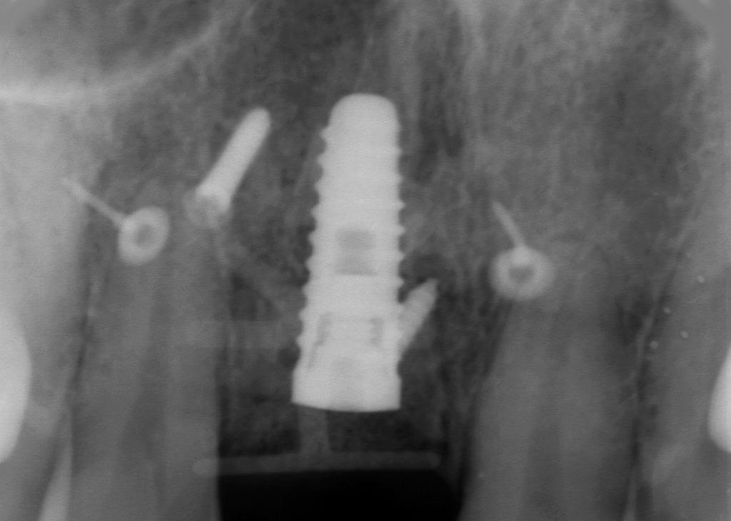 インプラント埋入直後のレントゲン：骨造成用スクリューを伴う初期状態