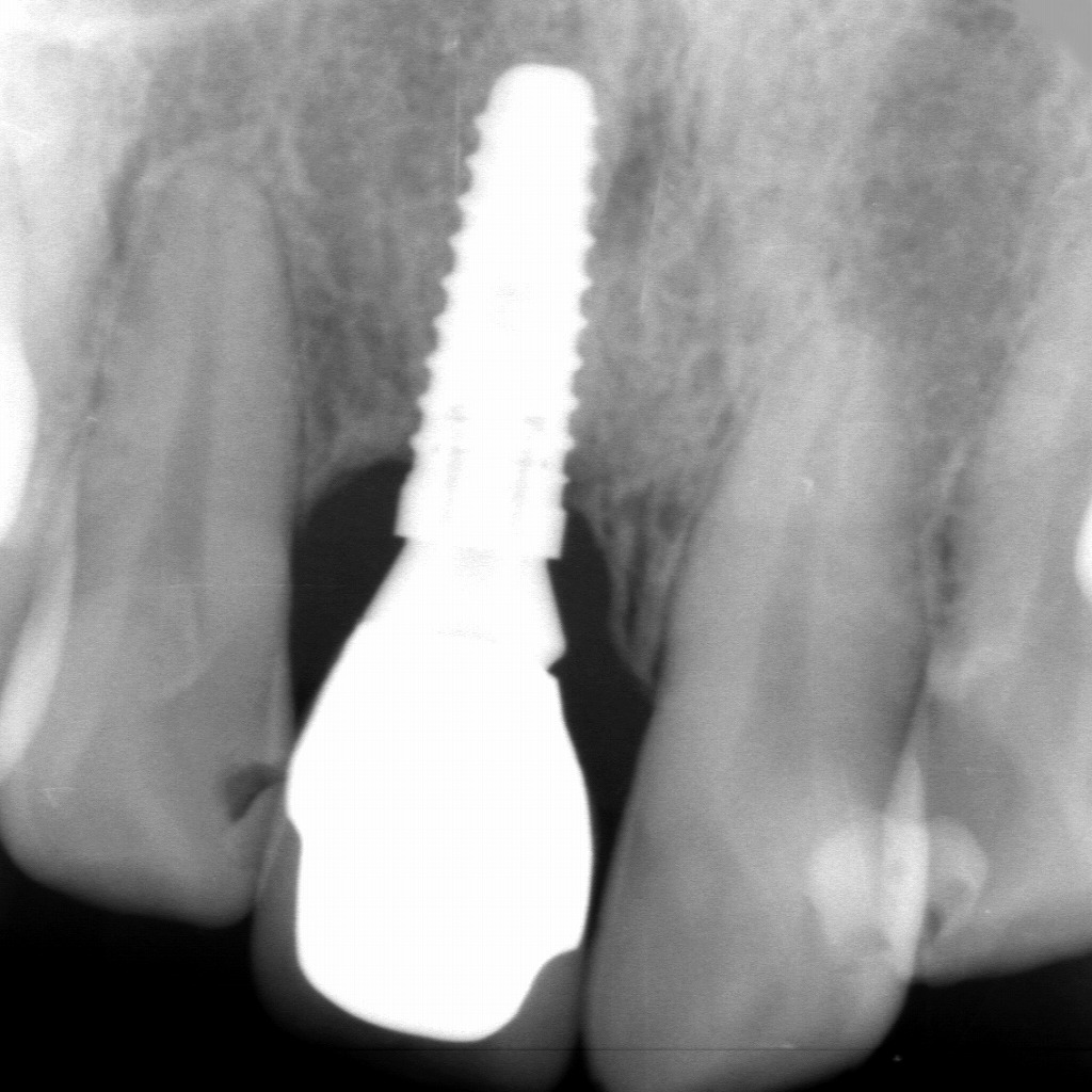 インプラント最終補綴装着後のレントゲン：骨レベルが安定した良好な経過