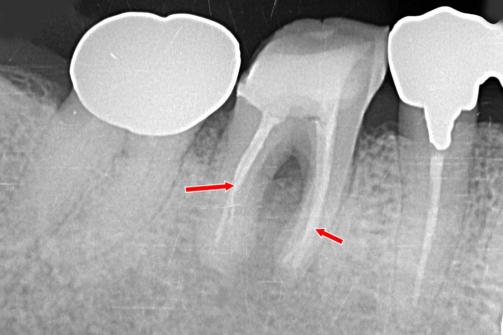 複雑な根管形態でも、各根管が適切に清掃・充填されていることが確認できます。