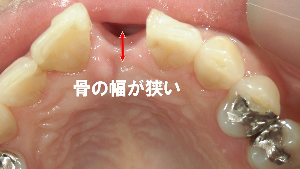 頬舌的な骨幅が狭い