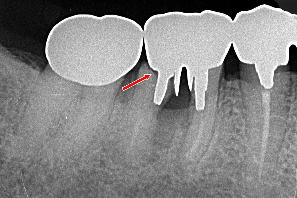 根分割後に補綴していた遠心根が縦破折し、透過像として確認される。