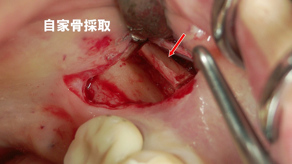下顎7番遠心頬側からの自家骨採取