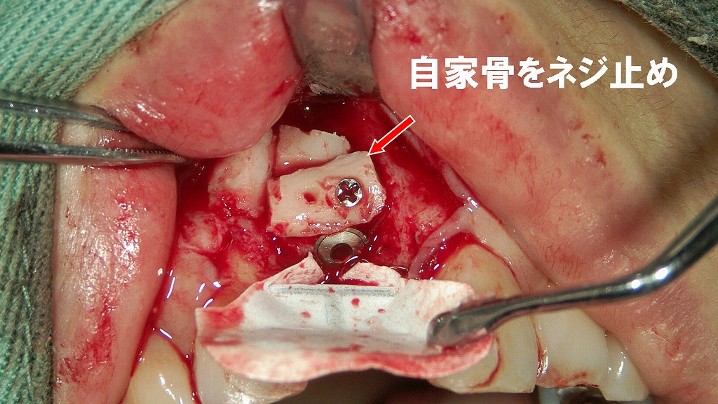 自家骨をインプラント部位へネジ固定