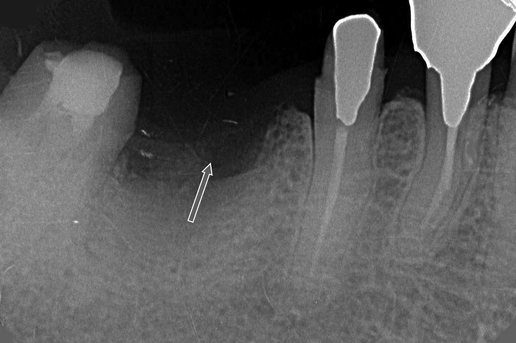 6番抜歯直後の抜歯窩が黒く透過像として確認される。