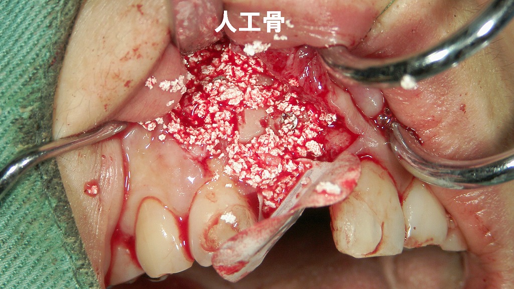 人工骨を填入して骨造成を行う段階