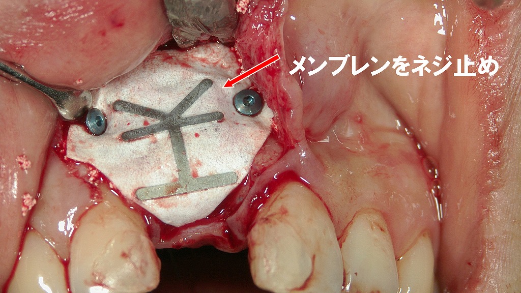 メンブレン固定によるGBR：骨造成部を確実に保護するステップ