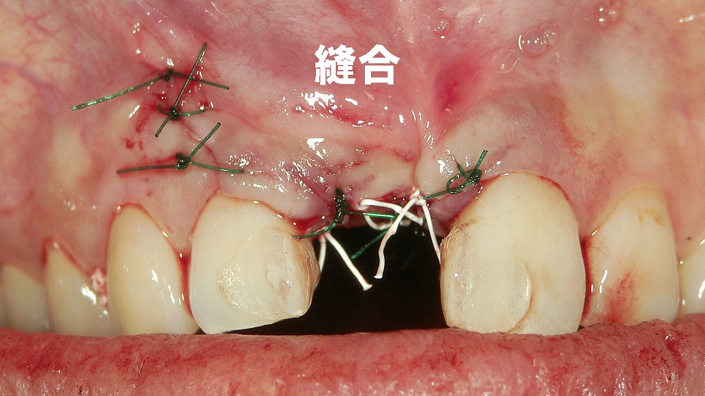 GBR後の創部を丁寧に縫合：骨造成を守る最終ステップ