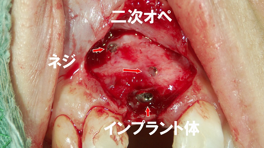 インプラント二次オペ：骨造成固定ネジを除去するステップ