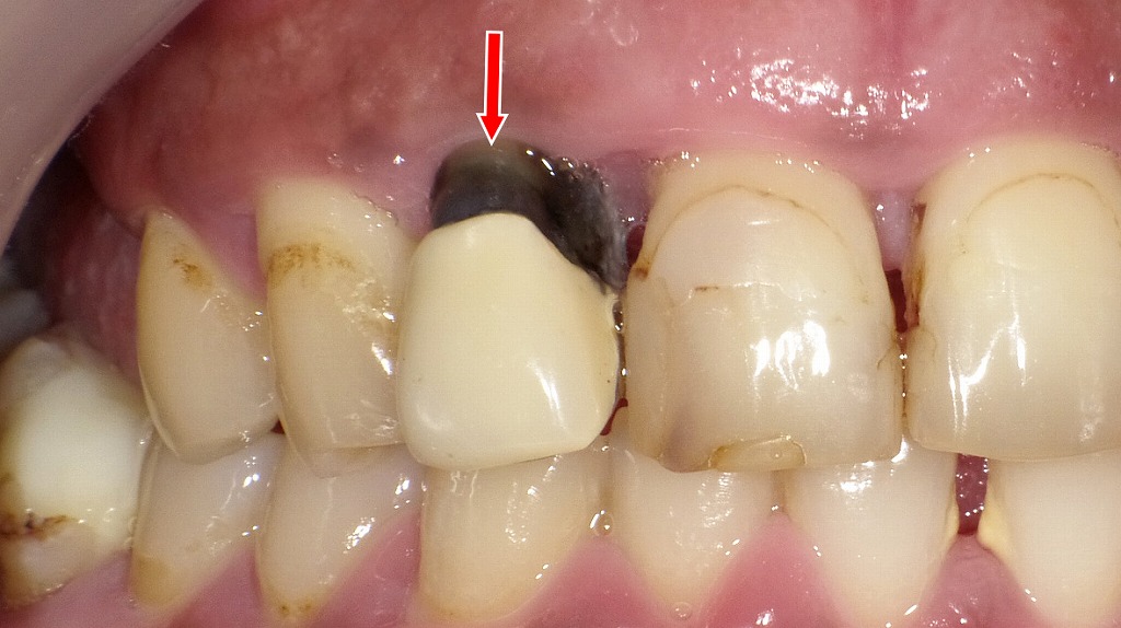 銀合金の土台（メタルコア）による歯根の黒変。金属イオンの溶出が原因