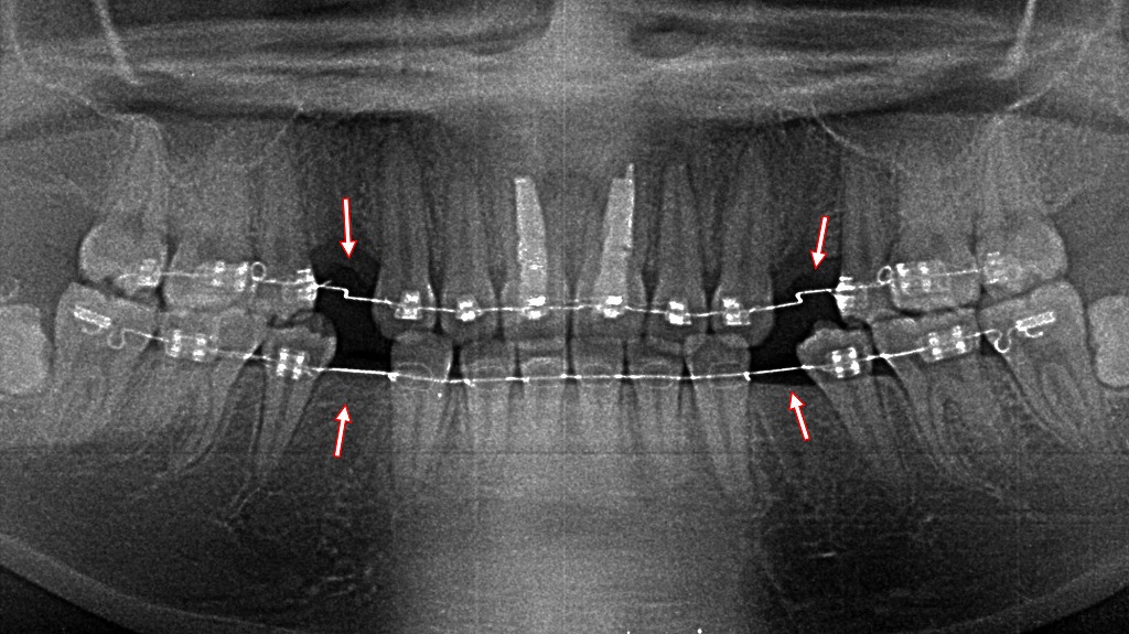 抜歯矯正中のパノラマレントゲン:矢印の4番を抜歯
