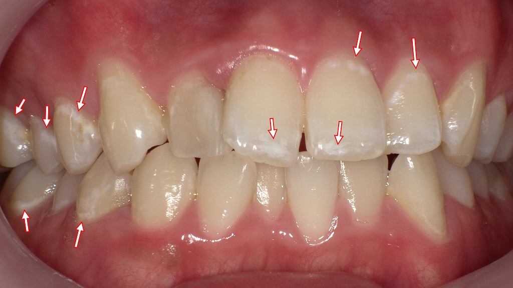 1枚目：ホワイトニング前