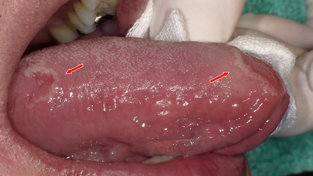 右側舌縁に白い縁取りを伴う紅斑を認める地図状舌の所見。