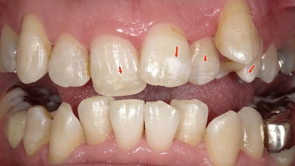 2枚目の画像:ホワイトニング後
