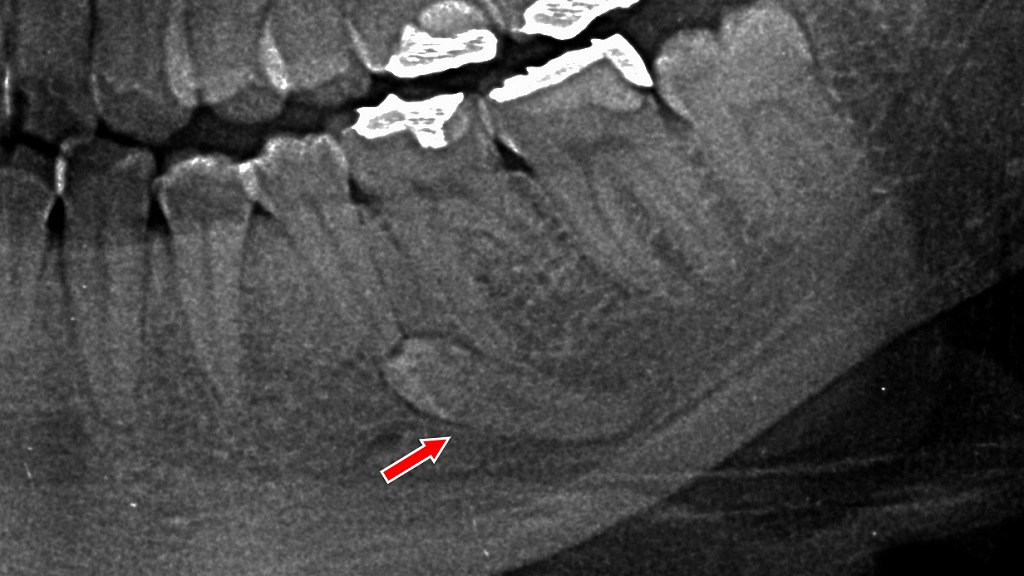 顎の中に眠る埋伏過剰歯