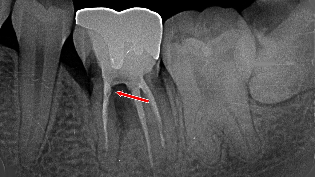 下顎6番:根管治療後に認められる病的歯根吸収(矢印部)