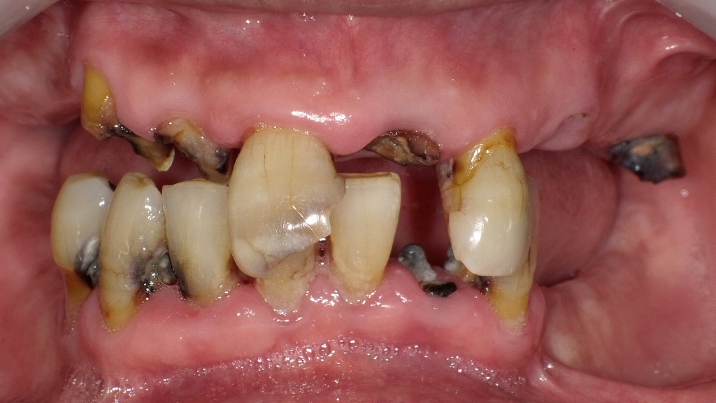 噛み合わせが崩壊した初診時の口腔内所見