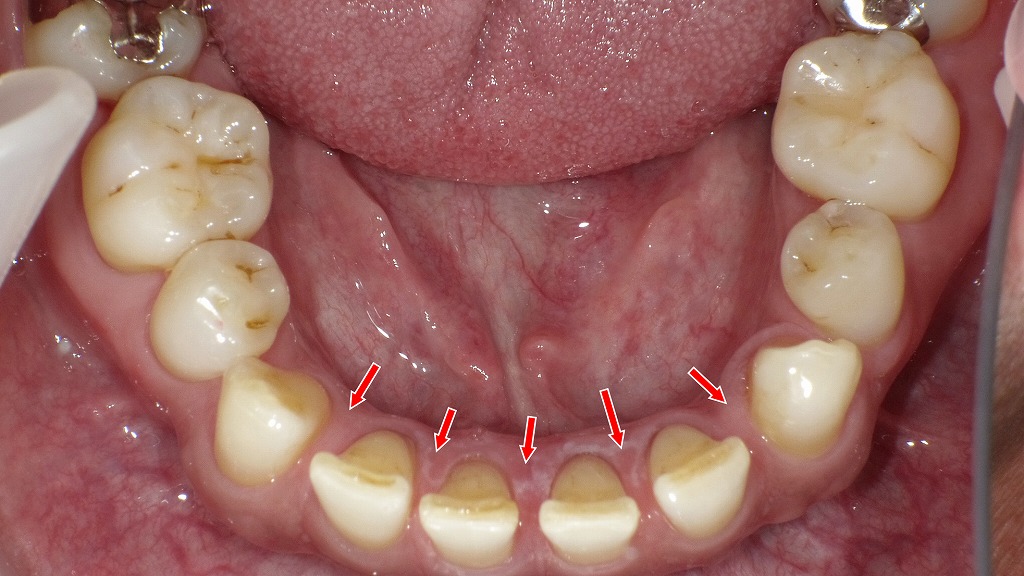 左右の第一小臼歯が先天欠損し、前歯部にスペースが余っている：咬合面観（下顎咬合面）