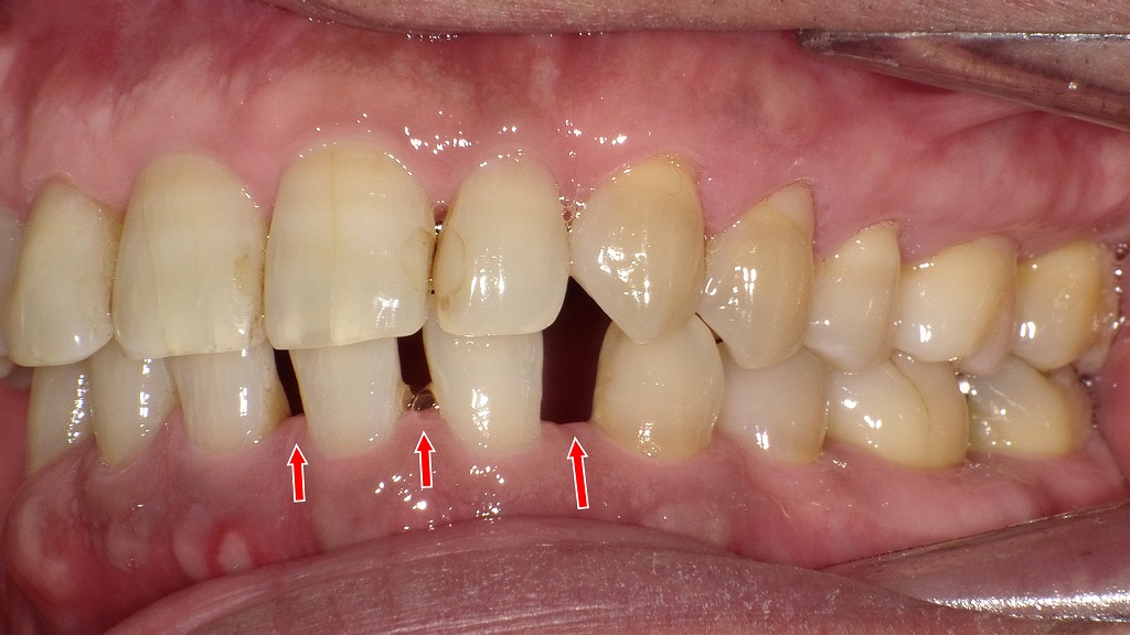 左側も4番欠損があり、前歯のすき間が固定化している歯列：左側面観