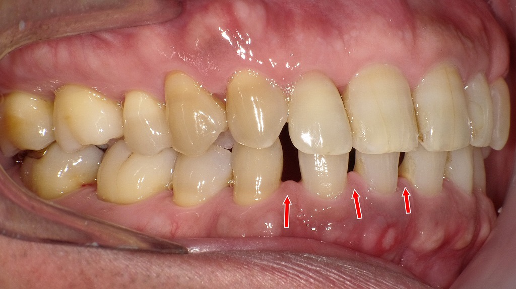 右側4番欠損により犬歯と側切歯の間に大きな空隙が残存：右側面観