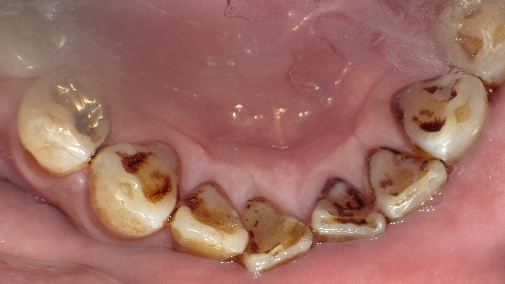 下顎前歯部舌側のステイン付着症例