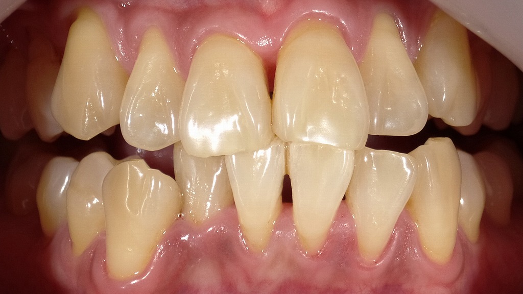 1枚目:ホワイトニング前