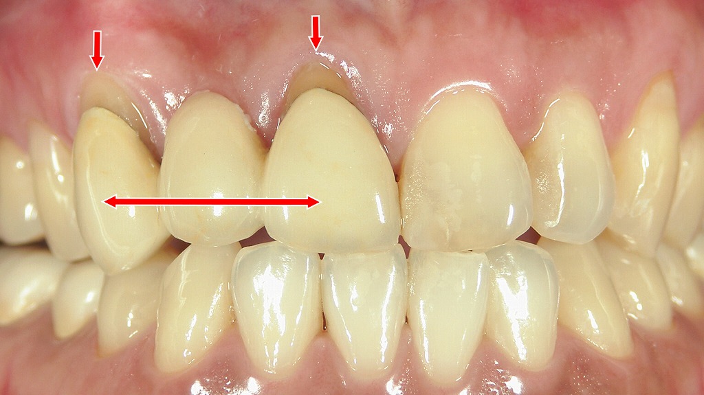 赤矢印は歯肉退縮、横矢印は1〜3番のメタルボンドブリッジ。支台歯の歯肉が下がり、境目が見えやすくなっています。